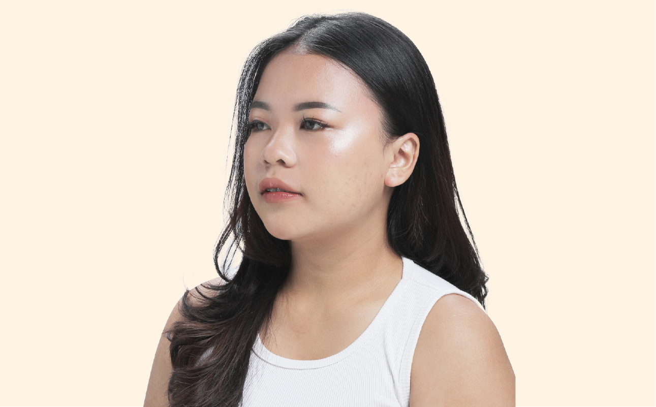 Acne_WEB bg revise_2